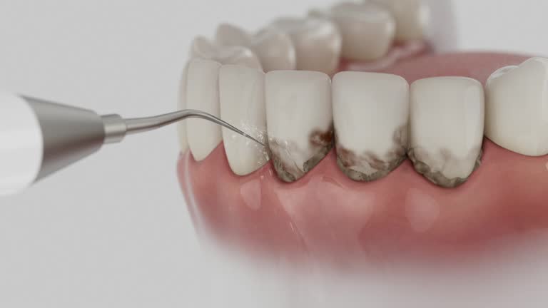 Trusted Wisdom Tooth Removal service in Duarte, CA - Dentist Open Now